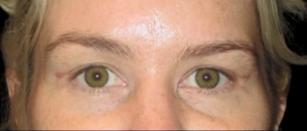 Sau: Phẫu thuật mí mắt trên (blepharoplasty) — eyes-closeup · thực hiện bởi Carisa Champion, DO