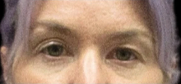 Trước: Phẫu thuật mí mắt trên (blepharoplasty) — eyes-closeup · thực hiện bởi Carisa Champion, DO