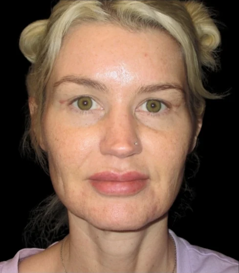 Sau: Phẫu thuật mí mắt trên (blepharoplasty) — mặt trước · thực hiện bởi Carisa Champion, DO
