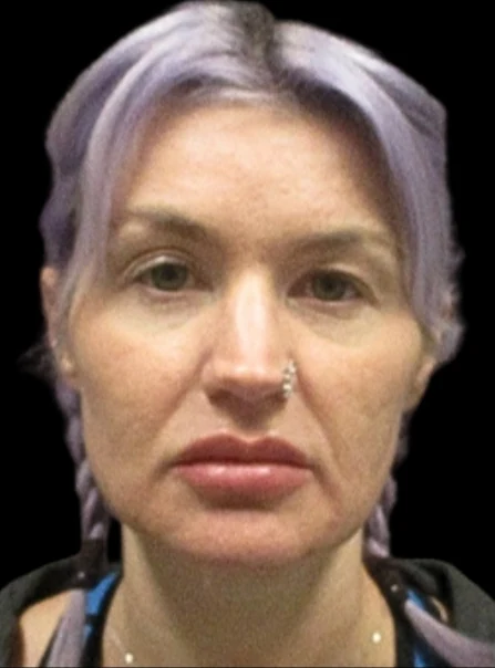 Trước: Phẫu thuật mí mắt trên (blepharoplasty) — mặt trước · thực hiện bởi Carisa Champion, DO