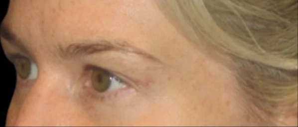 Sau: Phẫu thuật mí mắt trên (blepharoplasty) — profile-closeup · thực hiện bởi Carisa Champion, DO
