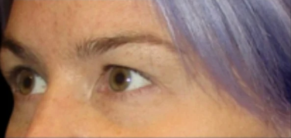 Trước: Phẫu thuật mí mắt trên (blepharoplasty) — profile-closeup · thực hiện bởi Carisa Champion, DO