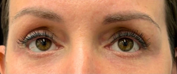 Sau: Phẫu thuật mí mắt dưới (blepharoplasty) · thực hiện bởi Angelo Cuzalina, MD, DDS