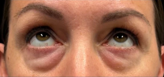 Trước: Phẫu thuật mí mắt dưới (blepharoplasty) · thực hiện bởi Angelo Cuzalina, MD, DDS