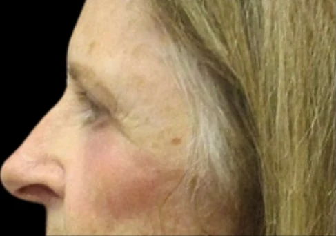 Sau: Phẫu thuật mí mắt trên/dưới & Tái tạo da bằng laser — profile-closeup · thực hiện bởi Angelo Cuzalina, MD, DDS