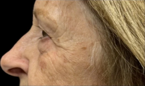 Trước: Phẫu thuật mí mắt trên/dưới & Tái tạo da bằng laser — profile-closeup · thực hiện bởi Angelo Cuzalina, MD, DDS
