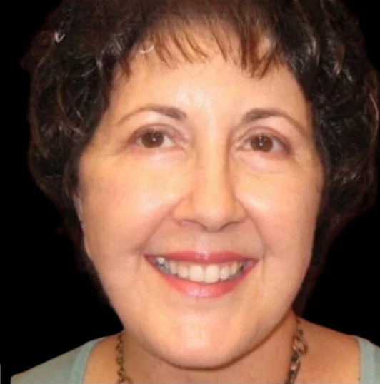 Sau: Phẫu thuật mí mắt (blepharoplasty) · thực hiện bởi Angelo Cuzalina, MD, DDS