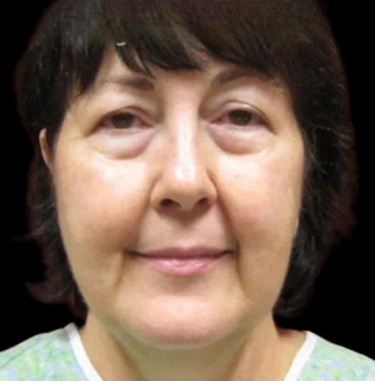Trước: Phẫu thuật mí mắt (blepharoplasty) · thực hiện bởi Angelo Cuzalina, MD, DDS