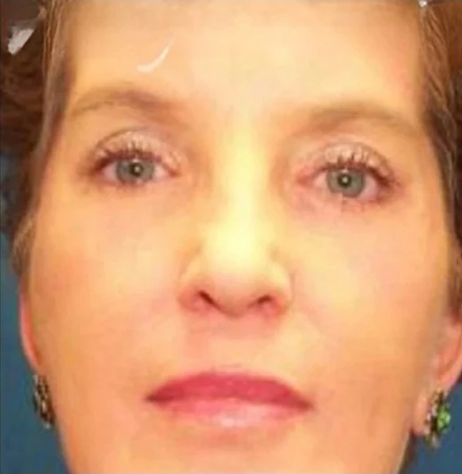 Sau: Phẫu thuật mí mắt (blepharoplasty) · thực hiện bởi Angelo Cuzalina, MD, DDS