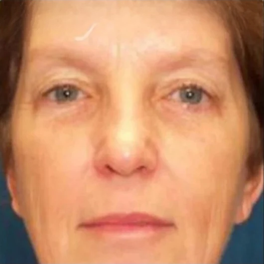Trước: Phẫu thuật mí mắt (blepharoplasty) · thực hiện bởi Angelo Cuzalina, MD, DDS