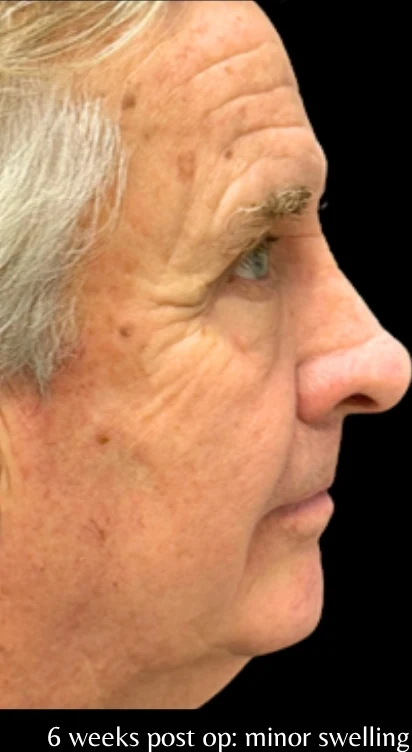 Sau: Phẫu thuật mí mắt (blepharoplasty) — nghiêng · thực hiện bởi Angelo Cuzalina, MD, DDS