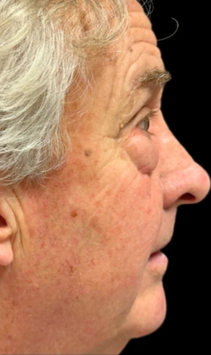 Trước: Phẫu thuật mí mắt (blepharoplasty) — nghiêng · thực hiện bởi Angelo Cuzalina, MD, DDS