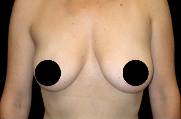 Trước: Nâng ngực đặt túi · thực hiện bởi Sebastian Gutierrez, MD
