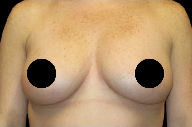 Trước: Nâng ngực đặt túi · thực hiện bởi Angelo Cuzalina, MD, DDS