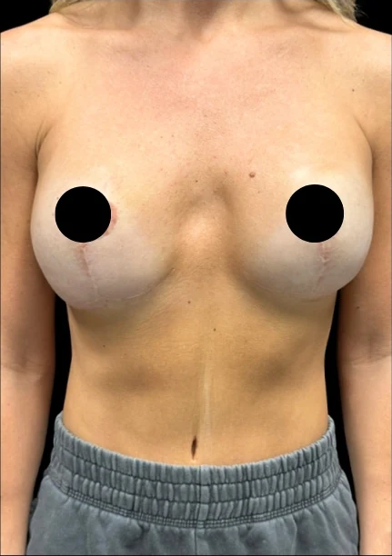 Trước: Nâng ngực đặt túi — mặt trước · thực hiện bởi Angelo Cuzalina, MD, DDS