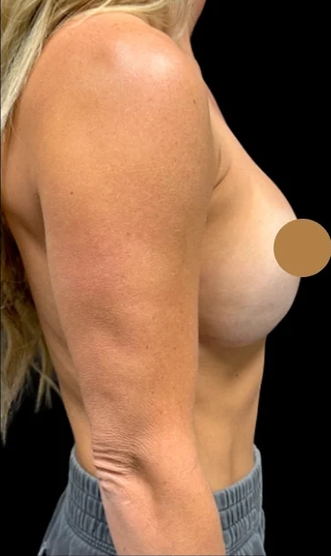 Trước: Nâng ngực đặt túi — nghiêng chéo · thực hiện bởi Angelo Cuzalina, MD, DDS