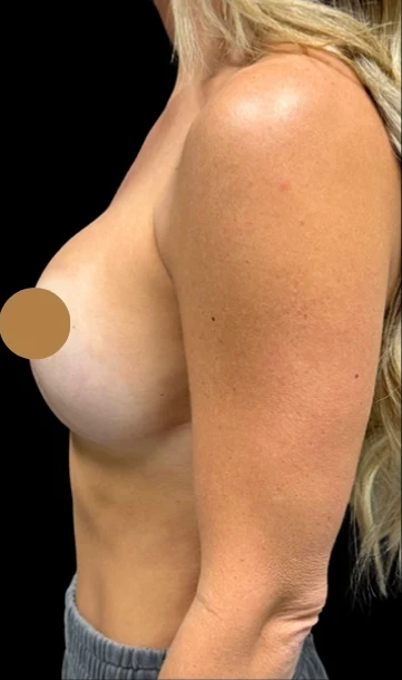 Trước: Nâng ngực đặt túi — nghiêng · thực hiện bởi Angelo Cuzalina, MD, DDS