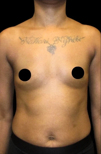 Trước: Nâng ngực đặt túi — mặt trước · thực hiện bởi Angelo Cuzalina, MD, DDS