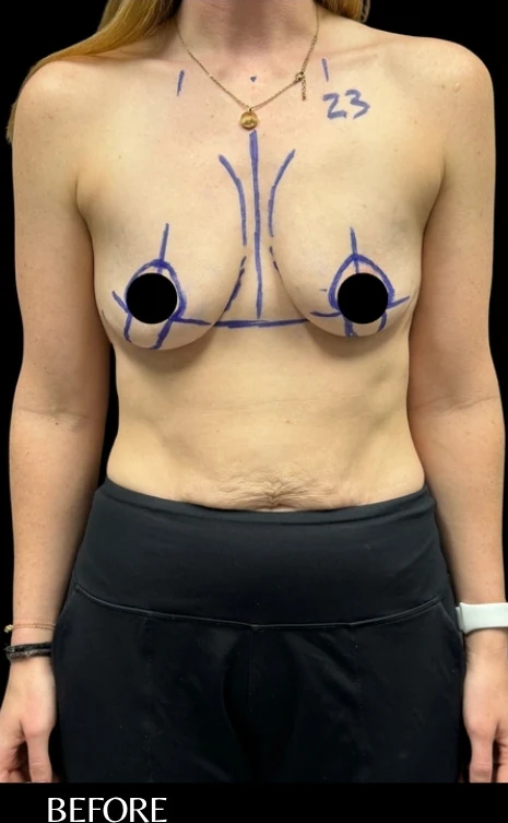Trước: Nâng ngực đặt túi · thực hiện bởi Angelo Cuzalina, MD, DDS