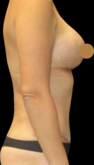 Sau: Nâng ngực đặt túi, Tạo hình thành bụng (tummy tuck), Lipo360 · thực hiện bởi Angelo Cuzalina, MD, DDS