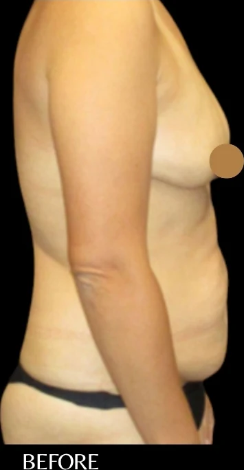 Trước: Nâng ngực đặt túi, Tạo hình thành bụng (tummy tuck), Lipo360 · thực hiện bởi Angelo Cuzalina, MD, DDS