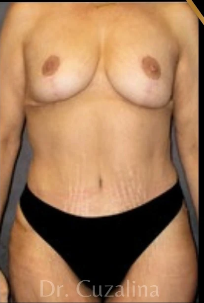 Sau: Treo ngực sa trễ không đặt túi, Tạo hình thành bụng (tummy tuck) toàn phần — mặt trước · thực hiện bởi Angelo Cuzalina, MD, DDS