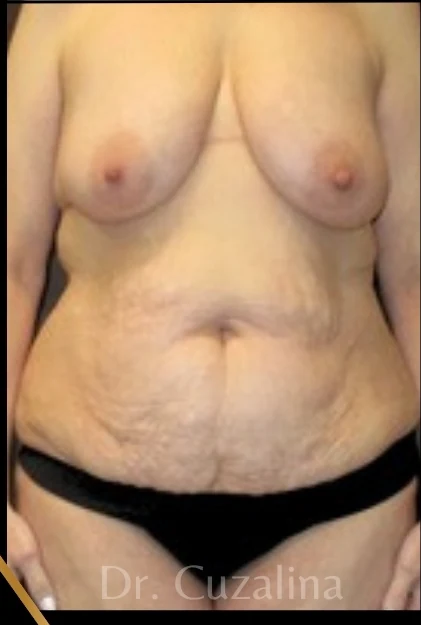Trước: Treo ngực sa trễ không đặt túi, Tạo hình thành bụng (tummy tuck) toàn phần — mặt trước · thực hiện bởi Angelo Cuzalina, MD, DDS