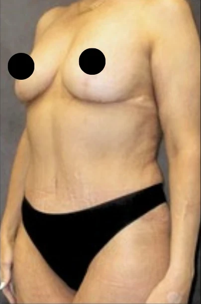 Sau: Treo ngực sa trễ không đặt túi, Tạo hình thành bụng (tummy tuck) toàn phần — nghiêng chéo · thực hiện bởi Angelo Cuzalina, MD, DDS