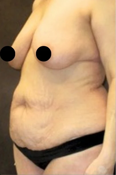 Trước: Treo ngực sa trễ không đặt túi, Tạo hình thành bụng (tummy tuck) toàn phần — nghiêng chéo · thực hiện bởi Angelo Cuzalina, MD, DDS