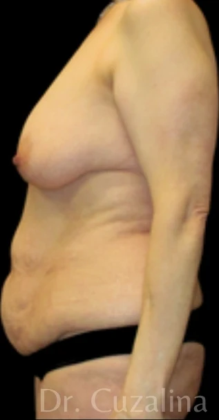 Trước: Treo ngực sa trễ không đặt túi, Tạo hình thành bụng (tummy tuck) toàn phần — nghiêng · thực hiện bởi Angelo Cuzalina, MD, DDS