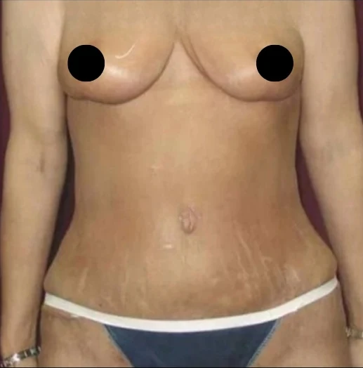 Sau: Thu nhỏ ngực & Treo ngực, Tạo hình thành bụng (tummy tuck), Hút mỡ 360 · thực hiện bởi Angelo Cuzalina, MD, DDS