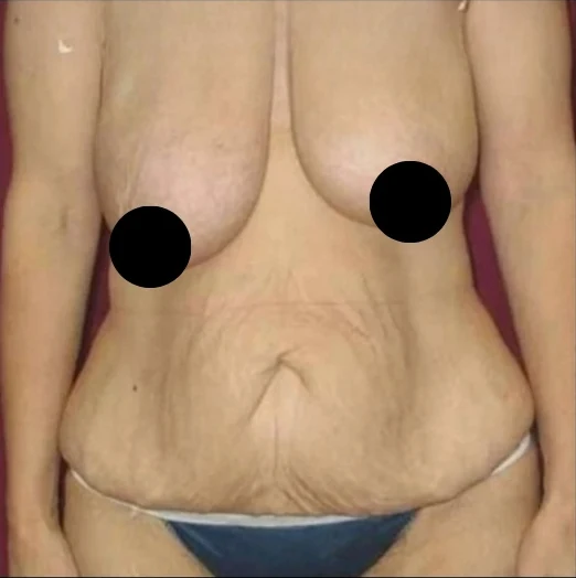 Trước: Thu nhỏ ngực & Treo ngực, Tạo hình thành bụng (tummy tuck), Hút mỡ 360 · thực hiện bởi Angelo Cuzalina, MD, DDS