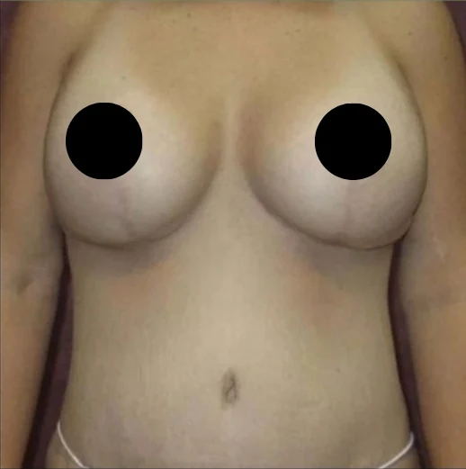 Sau: Thu nhỏ ngực & Treo ngực kết hợp đặt túi, Tạo hình thành bụng (tummy tuck), Hút mỡ 360 · thực hiện bởi Angelo Cuzalina, MD, DDS
