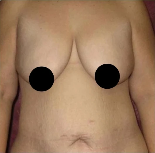 Trước: Thu nhỏ ngực & Treo ngực kết hợp đặt túi, Tạo hình thành bụng (tummy tuck), Hút mỡ 360 · thực hiện bởi Angelo Cuzalina, MD, DDS
