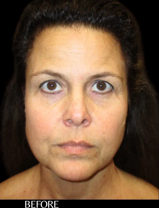 Trước: Nâng trán & Nâng chân mày qua nội soi — mặt trước · thực hiện bởi Angelo Cuzalina, MD, DDS
