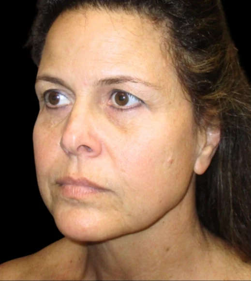 Trước: Nâng trán & Nâng chân mày qua nội soi — nghiêng ba phần tư · thực hiện bởi Angelo Cuzalina, MD, DDS