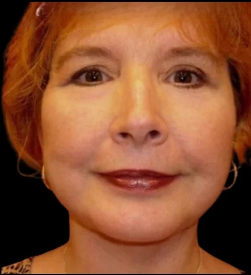 Sau: Phẫu thuật mí mắt (blepharoplasty), Độn cằm, Căng da mặt dưới lớp sâu (deep plane) · thực hiện bởi Angelo Cuzalina, MD, DDS