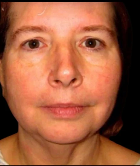 Trước: Phẫu thuật mí mắt (blepharoplasty), Độn cằm, Căng da mặt dưới lớp sâu (deep plane) · thực hiện bởi Angelo Cuzalina, MD, DDS