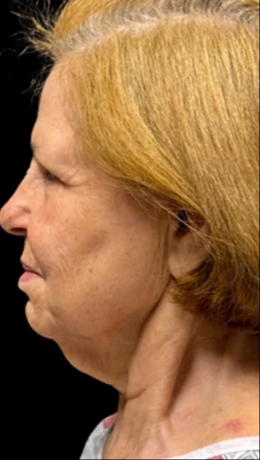Trước: Căng da mặt dưới & Căng da cổ · thực hiện bởi Angelo Cuzalina, MD, DDS