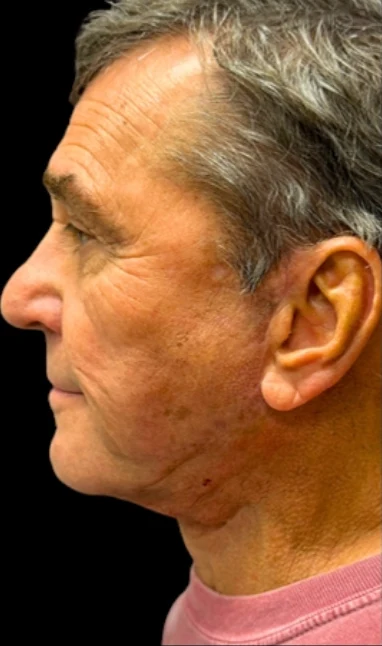 Sau: Căng da mặt dưới & Căng da cổ — nghiêng · thực hiện bởi Angelo Cuzalina, MD, DDS