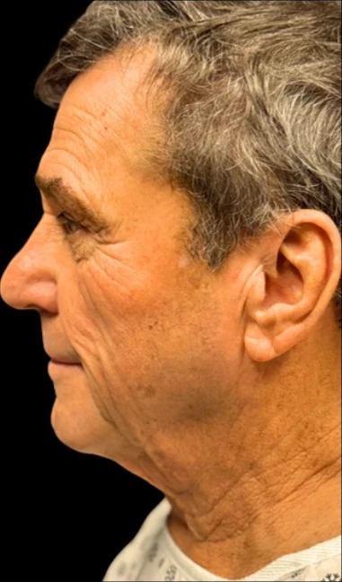 Trước: Căng da mặt dưới & Căng da cổ — nghiêng · thực hiện bởi Angelo Cuzalina, MD, DDS