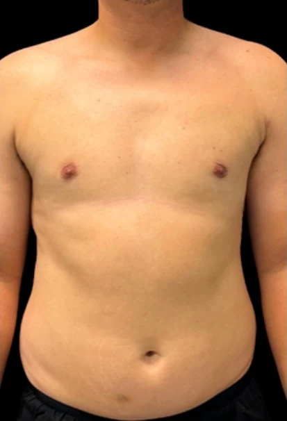 Sau: Hút mỡ ngực, Cắt bỏ mô với Vaser — mặt trước · thực hiện bởi Angelo Cuzalina, MD, DDS