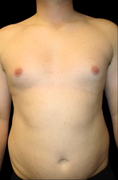 Trước: Hút mỡ ngực, Cắt bỏ mô với Vaser — mặt trước · thực hiện bởi Angelo Cuzalina, MD, DDS