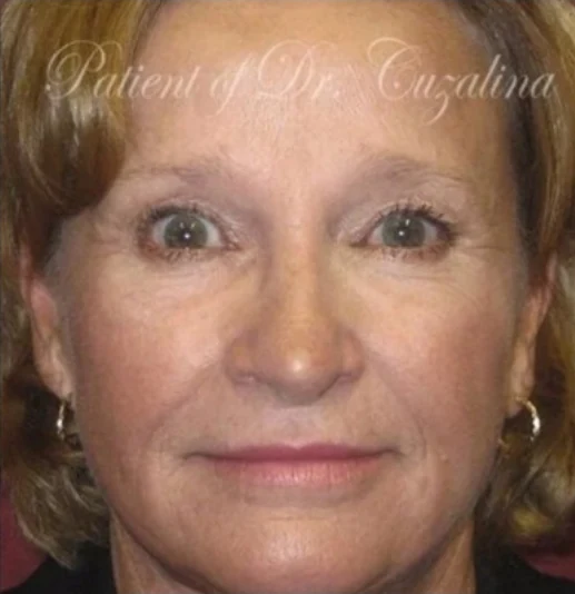 Sau: Phẫu thuật mí mắt (blepharoplasty), Tái tạo da bằng laser, Nâng chân mày · thực hiện bởi Angelo Cuzalina, MD, DDS