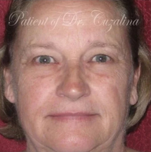 Trước: Phẫu thuật mí mắt (blepharoplasty), Tái tạo da bằng laser, Nâng chân mày · thực hiện bởi Angelo Cuzalina, MD, DDS