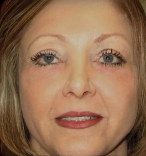 Sau: Phẫu thuật mí mắt (blepharoplasty), Tái tạo bề mặt da bằng laser · thực hiện bởi Angelo Cuzalina, MD, DDS