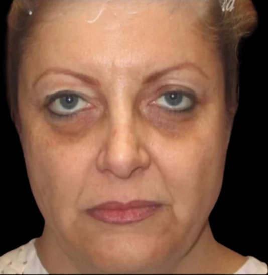 Trước: Phẫu thuật mí mắt (blepharoplasty), Tái tạo bề mặt da bằng laser · thực hiện bởi Angelo Cuzalina, MD, DDS