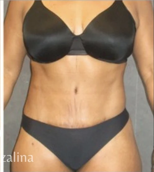 Sau: Tạo hình thành bụng (tummy tuck) & Hút mỡ vùng eo & hông — mặt trước · thực hiện bởi Angelo Cuzalina, MD, DDS
