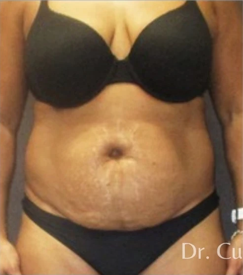 Trước: Tạo hình thành bụng (tummy tuck) & Hút mỡ vùng eo & hông — mặt trước · thực hiện bởi Angelo Cuzalina, MD, DDS