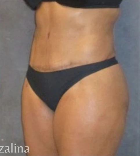 Sau: Tạo hình thành bụng (tummy tuck) & Hút mỡ vùng eo & hông — nghiêng chéo · thực hiện bởi Angelo Cuzalina, MD, DDS